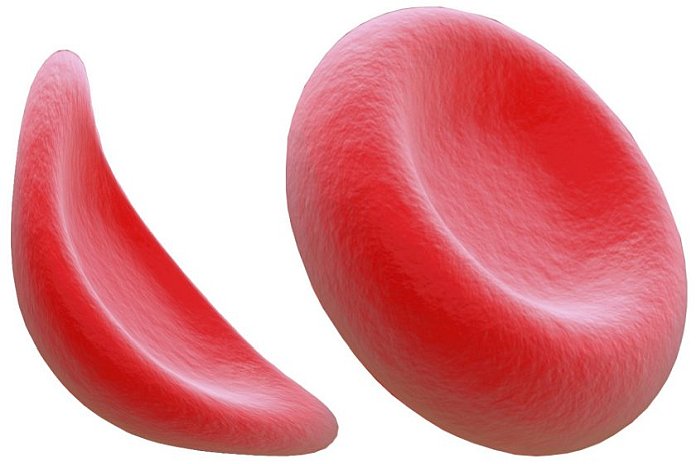 sickle_cell