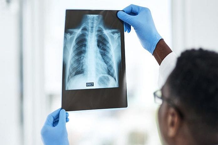 who_ tuberculosis
