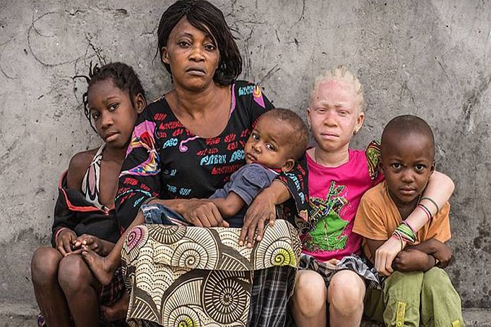 albinism