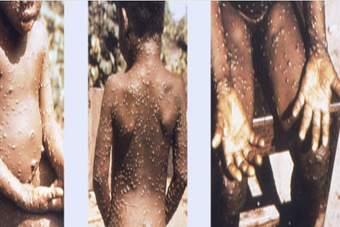 monkeypox