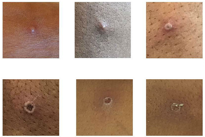 monkeypox_uk