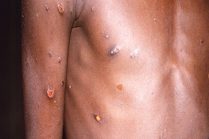 monkeypox