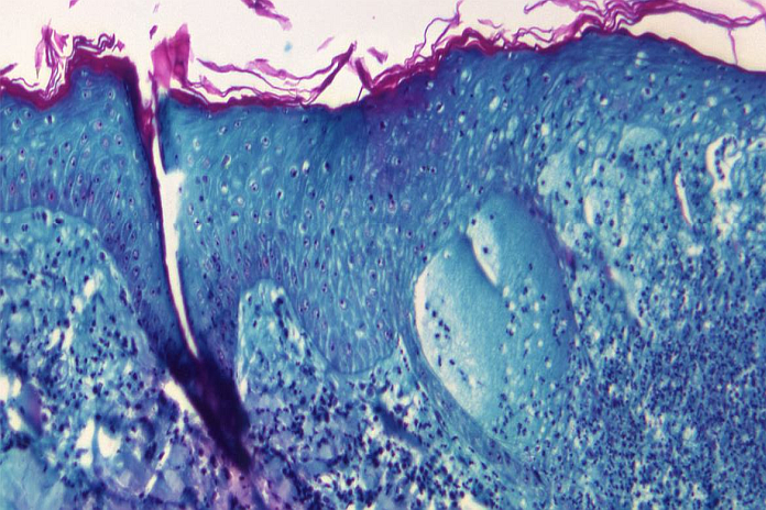monkeypox_virus