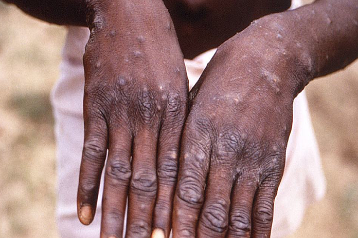 monkeypox