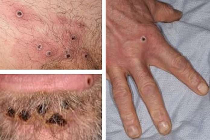 monkeypox_hand