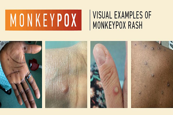 monkeypox_who
