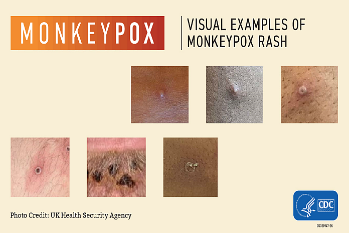 monkeypox_cdc