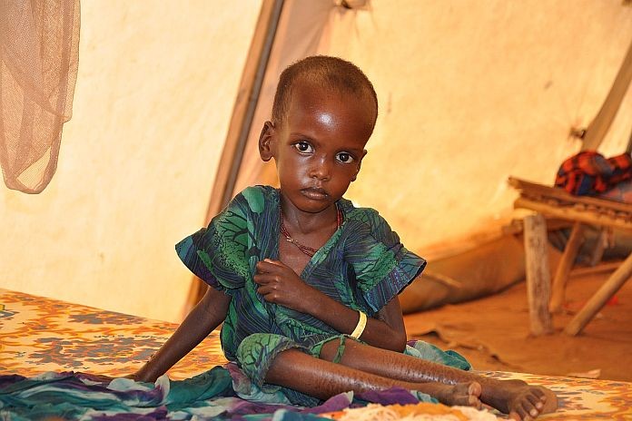 malnutrition