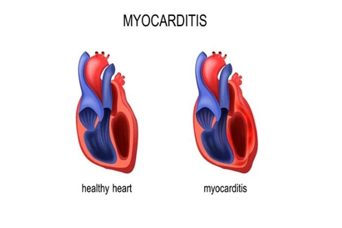 myocarditis