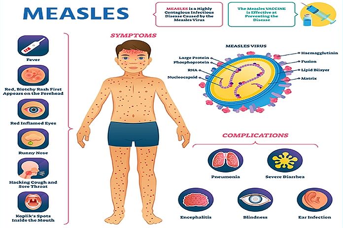 measles_cng