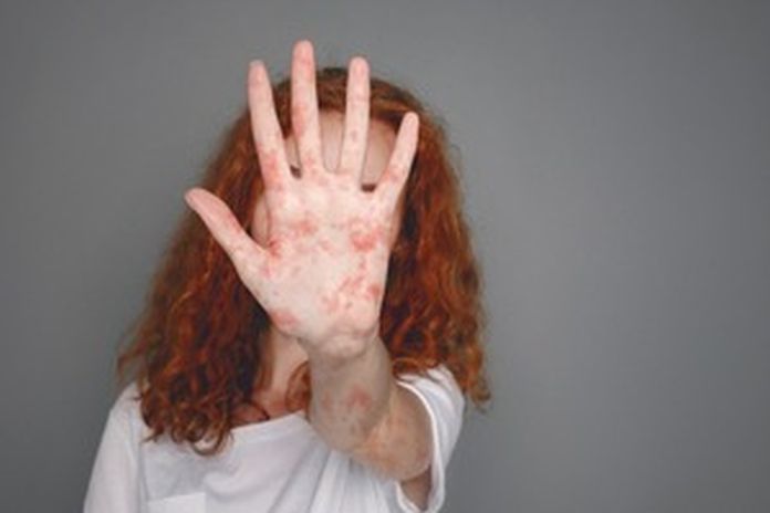 measles_uk
