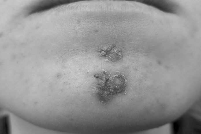Impetigo_ montserrat-24jpg