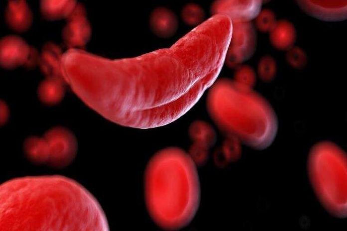 sicklecell_disease